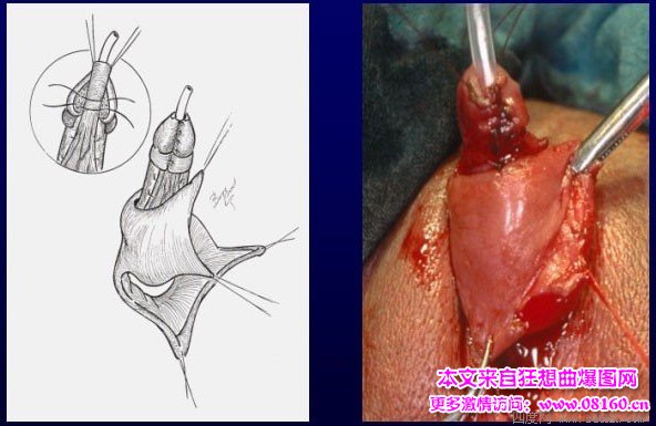 泰国男变性女手术视频，女人变性手术过程照片