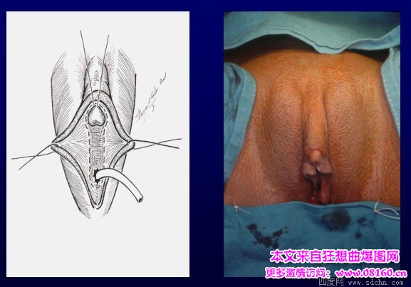 泰国男变性女手术视频，女人变性手术过程照片