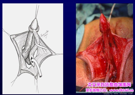 泰国男变性女手术视频，女人变性手术过程照片