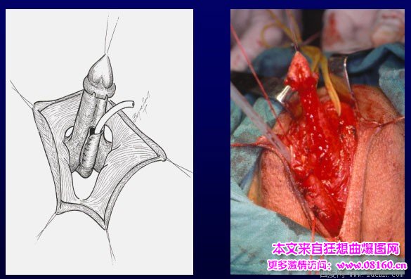 泰国男变性女手术视频，女人变性手术过程照片