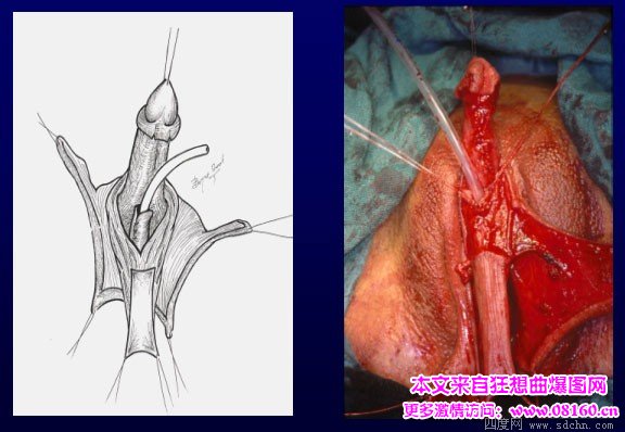 泰国男变性女手术视频，女人变性手术过程照片