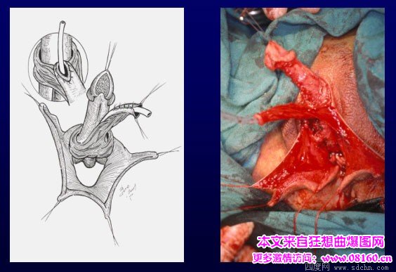 泰国男变性女手术视频，女人变性手术过程照片