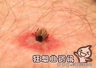 2岁女童头上发现蜱虫，蜱虫能咬死人吗？