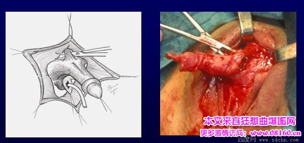 泰国男变性女手术视频，女人变性手术过程照片